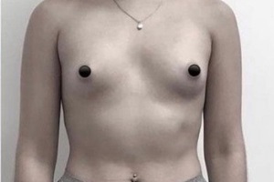 Breast Augmentation Before Miami