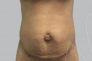 Tummy Tuck Before Miami