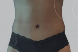 Tummy Tuck After Miami